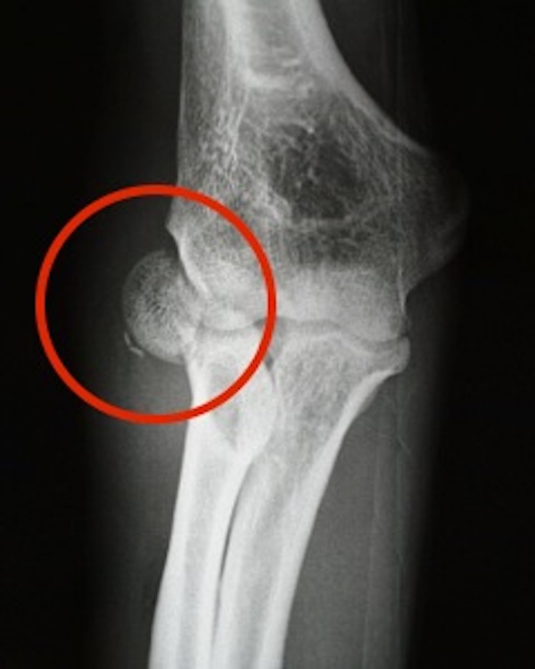 Radial head fracture